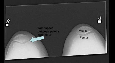 Radiography - Knee Injury and Prevention