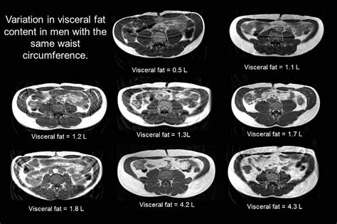 Difference Between Visceral Fat and Subcutaneous Fat | Compare the ...