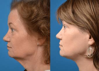 Non Surgical Neck Lift, dr oz, Laser, Exercises, Tightening without ...