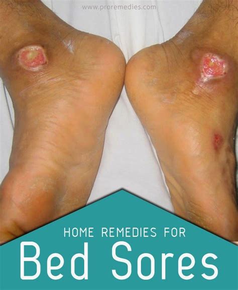 Home Remedies For Bed Sores | Bed sores, Health heal, Home remedies