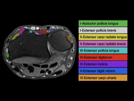 Wrist Extensor Tendons
