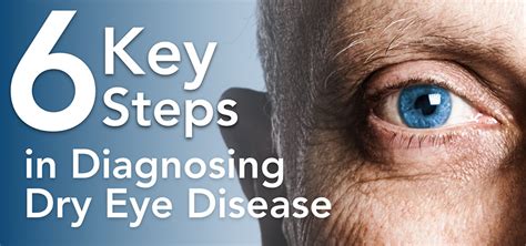 Diagnosing Dry Eye Disease: Where to Start - Dry Eye Access