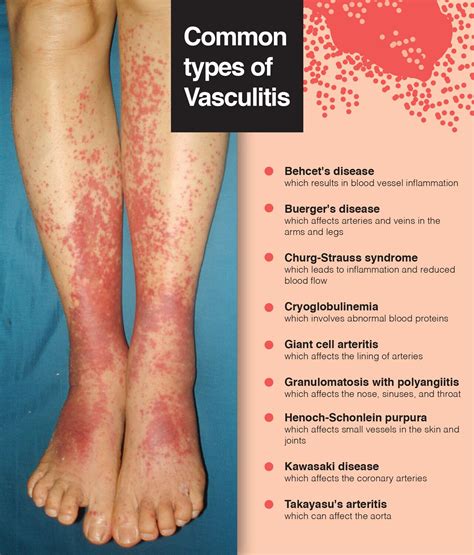 Vasculitis: Signs, Symptoms, Causes, Treatment – The Amino Company