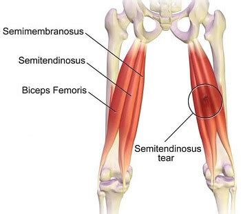 Semitendinosus Muscle (Hamstrings) - Knee Pain Explained