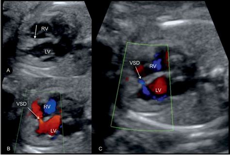 Ventricular Septal Defect