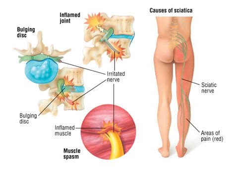 Pinched Nerve Leg Treatment