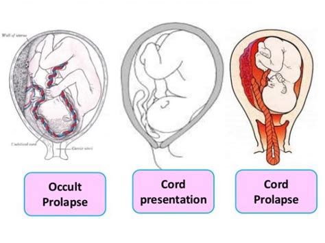 Umbilical Cord Accidents | Best Hospital in Trivandrum for High Risk ...