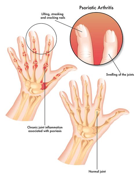 Psoriatic Arthritis - Arizona Arthritis & Rheumatology Associates, P.C.