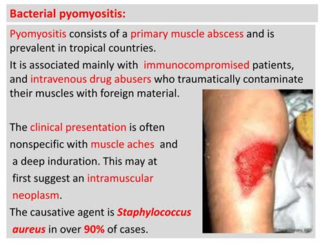 PPT - Infectious Myositis: PowerPoint Presentation, free download - ID ...