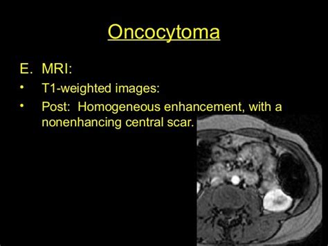 Oncocytoma