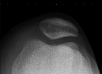 Sunrise radiograph of the patella. | Download Scientific Diagram