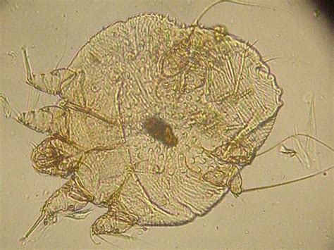 Scabies Bites: Pictures, Symptoms, and Treatments