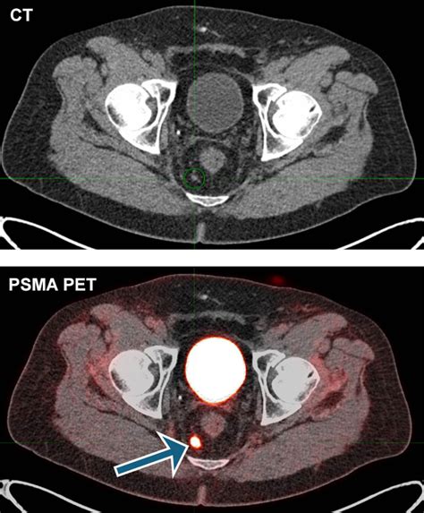 Doctors can see prostate cancer anywhere in the body with PSMA PET ...