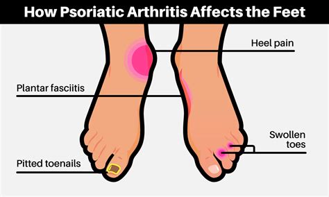 8 Ways To Manage Psoriatic Arthritis Foot Pain | MyPsoriasisTeam