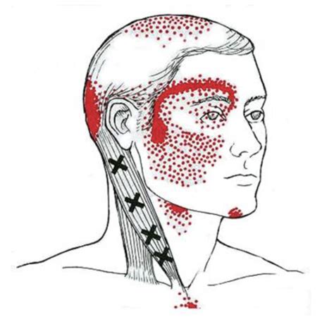 Cervicogenic headache - Dr. Justin Dean