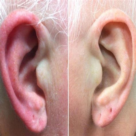 Eczema on Ear - How to Get Rid of Itchy or Dry Ear Eczema?