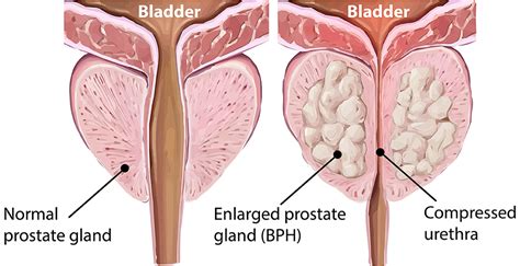 BPH Symptoms, Risk, and Diagnosis | Saint John’s Cancer Institute