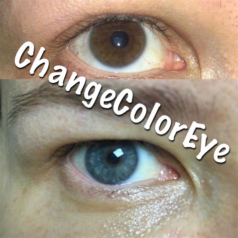 laser eye color change,eye color change turkey,eye color change result ...