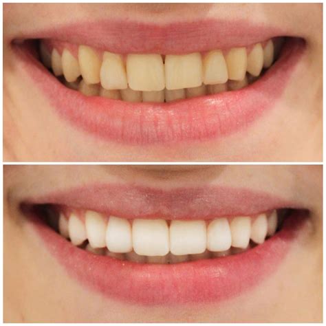 Teeth Whitening Brisbane [Free Consult] | Smiling Dental