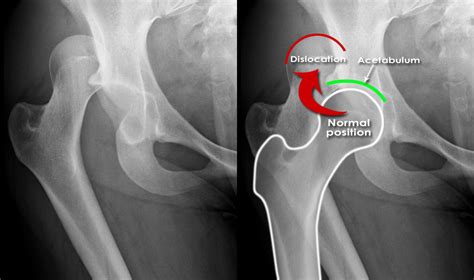 Posterior Hip Dislocation Presentation