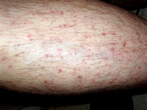 Red Spots On Legs Pictures Symptoms Causes Treatment Diseases | Images ...