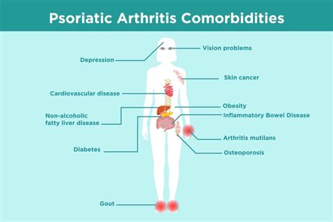 Psoriatic Arthritis Comorbidities: What Patients Need to Know