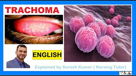 TRACHOMA / CAUSES, TREATMENT AND PREVENTIVE MEASURES OF TRACHOMA / EYE ...