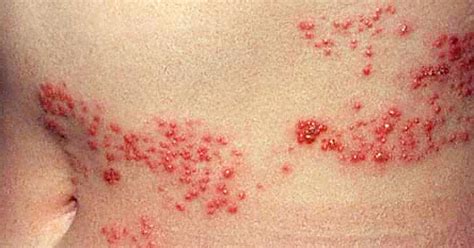 Is it shingles? 7 myths about painful illness (graphic images) - CBS News