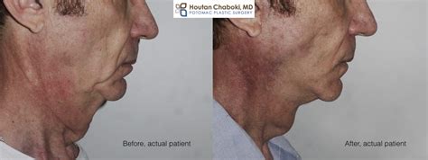 Facelift and Neck Lift Surgery in Men – Potomac Plastic Surgery