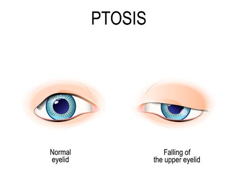 Overview Of Ptosis Causes And Treatment | Fort Lauderdale Eye Institute