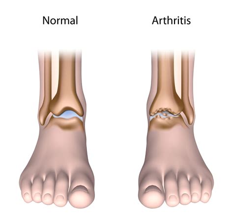 Ankle Osteoarthritis - Colorado Pain Care