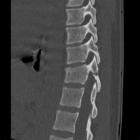 Chance fracture | Radiology Case | Radiopaedia.org