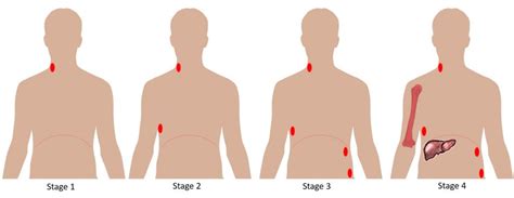 Lymphoma - Pathophysiology - Management - TeachMePaediatrics