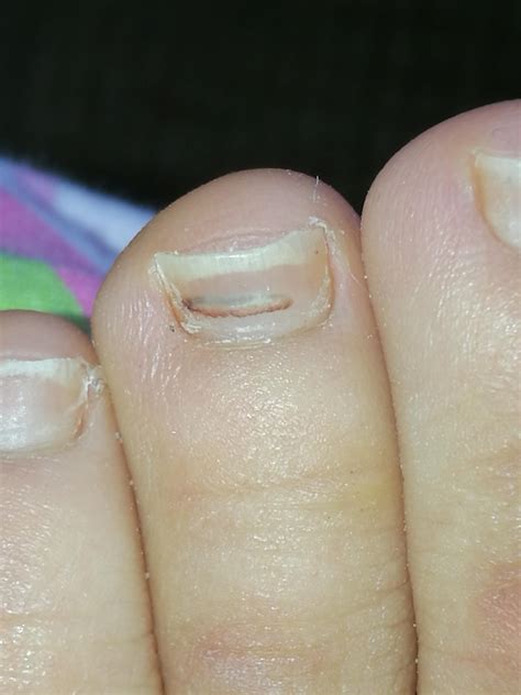 Why Do My Toenails Have Brown Spots at Helen Hebert blog