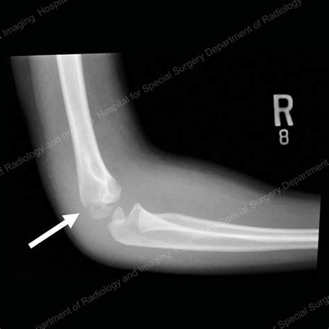 Elbow Fractures in Children: An Overview - HSS.edu