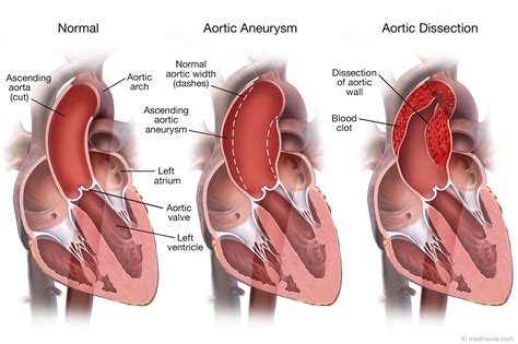 Aortic Aneurysm and Aortic Dissection – Medmovie.com