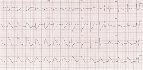 Inferior STEMI • LITFL • ECG Library Diagnosis