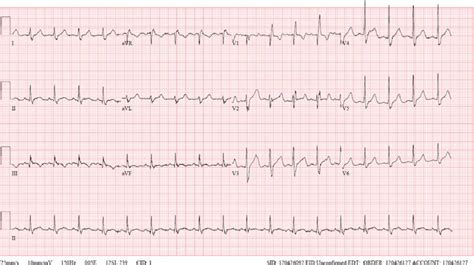 Sinus Tachycardia