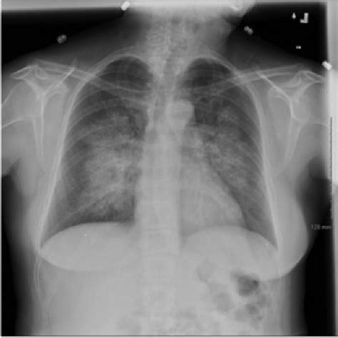 Chest plain film x-ray during admission in 2014 revealed extensive ...