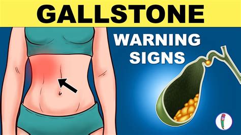 Gallbladder Stones Symptoms | Cholelithiasis | Gallstones Symptoms ...