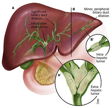 Bile Duct Cancer (Cholangiocarcinoma) | Johns Hopkins Medicine