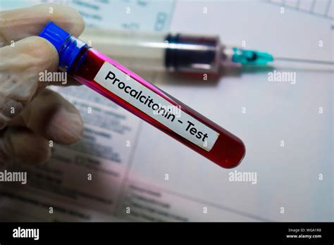 Procalcitonin hi-res stock photography and images - Alamy