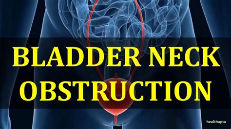 BLADDER NECK OBSTRUCTION - YouTube