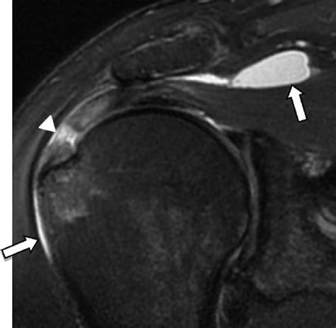 Subacromial Bursitis Mri | The Best Porn Website