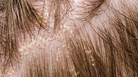 What Is Scalp Eczema? Symptoms, Causes, Treatment, and More