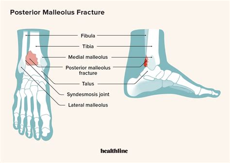 Posterior Malleolus törés kezelése és felépülése - Orvos 24