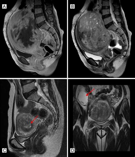 Large Fibroid Uterus Surgery