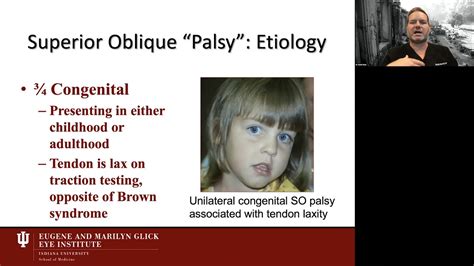 Inferior Oblique Palsy