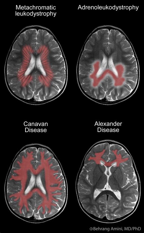 Roentgen Ray Reader: Dysmyelinating Disorders (Leukodystrophies)