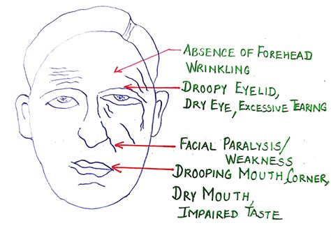 What are causes of Bell's Palsy